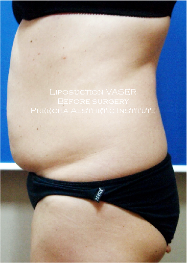 Before vaser liposuction 1