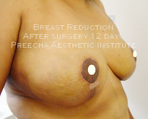 Breast Reduction after 12 days