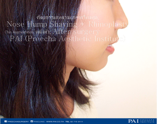 Chin Augmentation after 10 days surgery l Preecha Aesthetic Institute