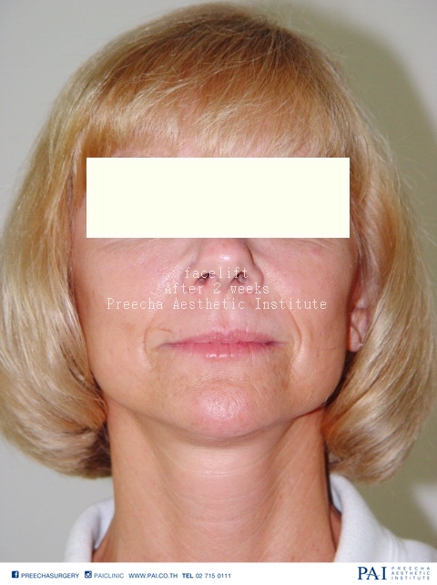 Full facelift after surgery l preecha aesthetic institute
