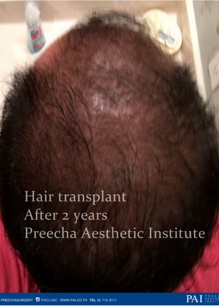 Hair transplant after 2 years at preecha aesthetic institute