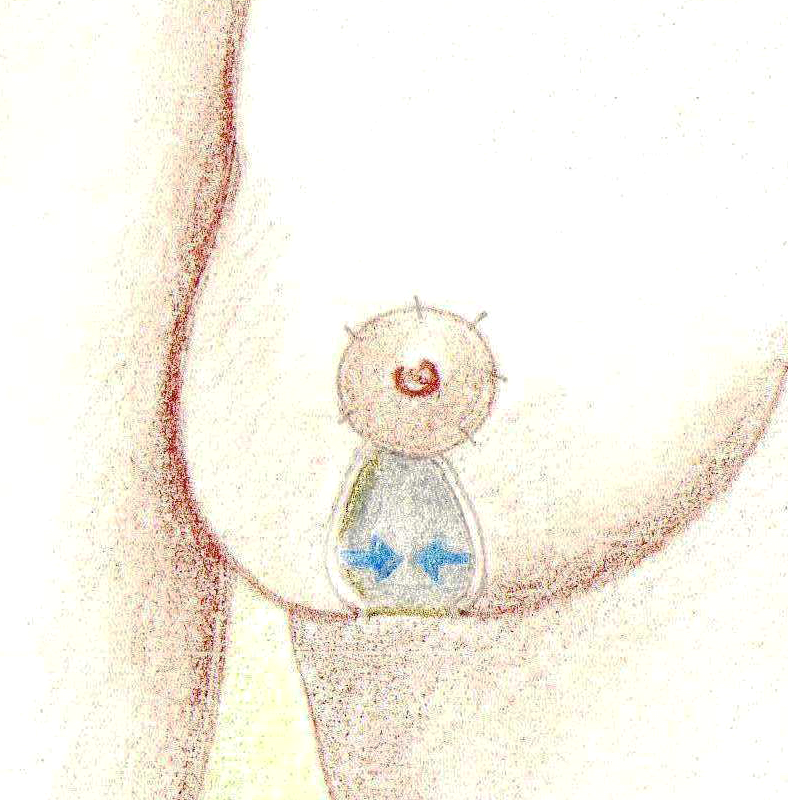 Incision breast reduction sample drawing