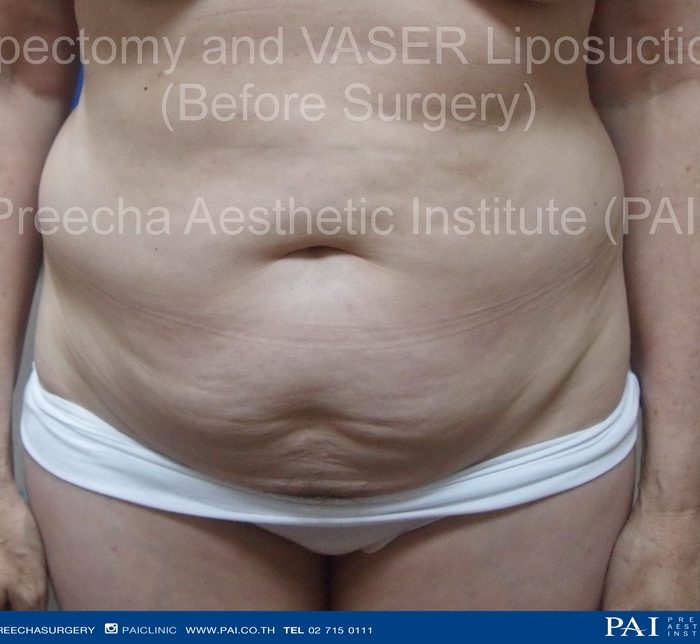 Lipectomy and VASER LipoSelection