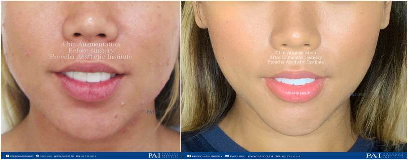 SAMPLE BEFORE AFTER one year CHIN AUGMENTATION SURGERY