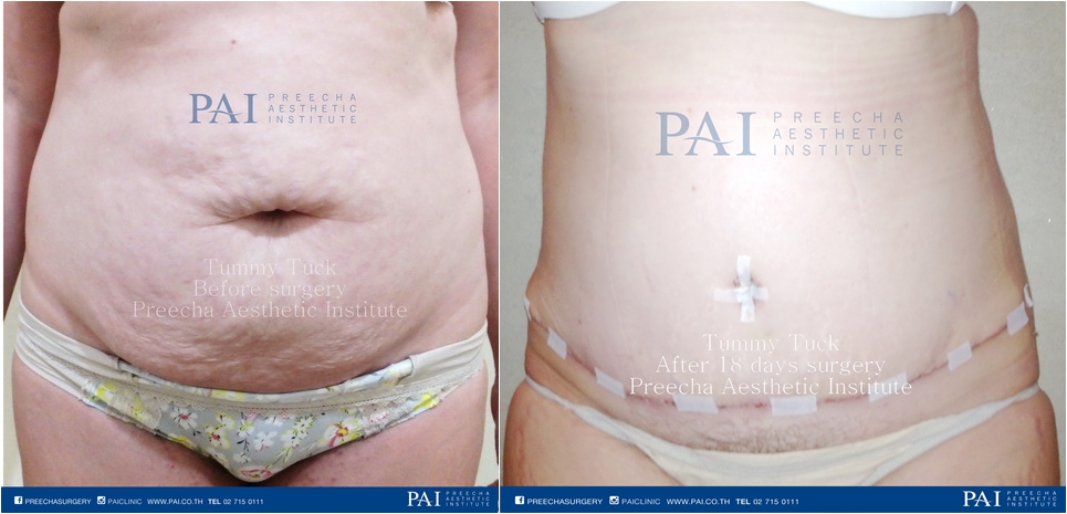 Tummy Tuck before and after surgery PAI cosmetic surgery thailand