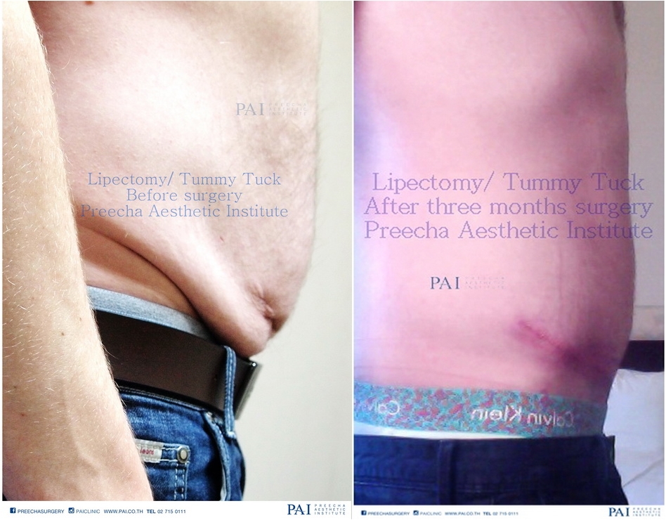 Tummy Tuck before and after three months surgery