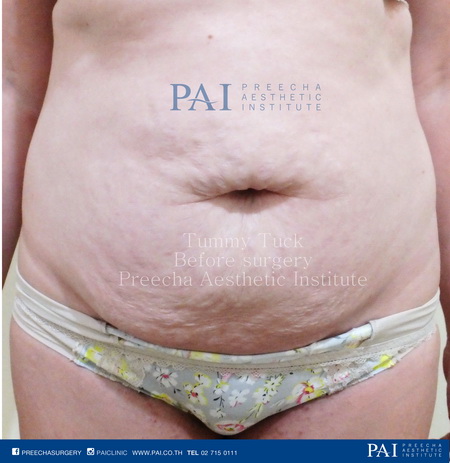 Tummy Tuck before surgery PAI cosmetic surgery thailand