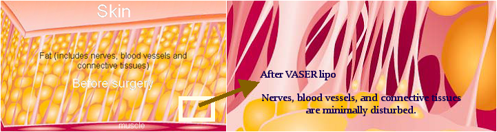Use of VASER Lipo before after surgery