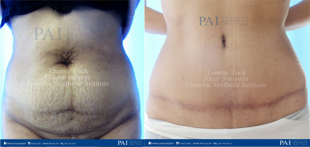 abdominoplasty before and after surgery l preecha aesthetic institute bangkok thailand