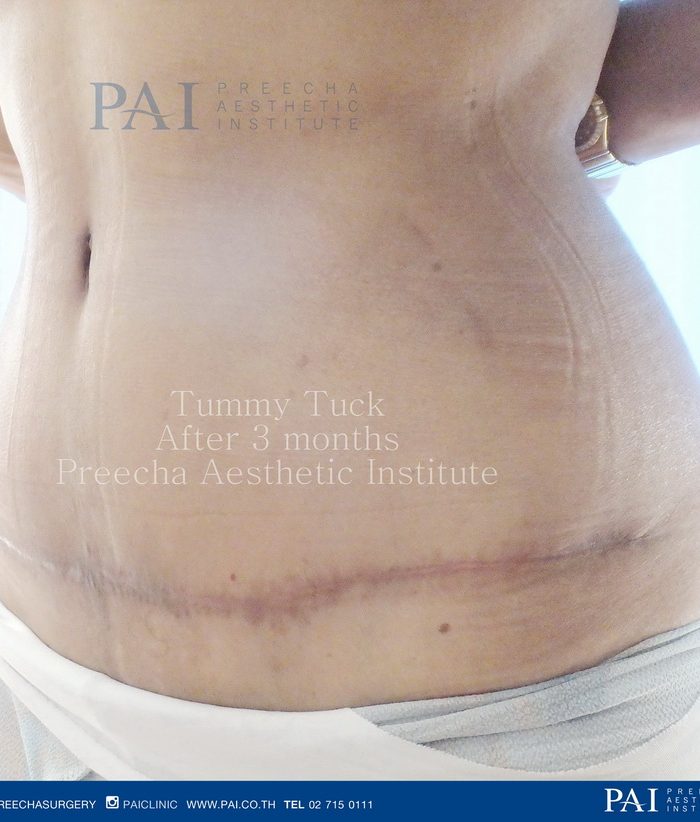 abdominoplasty tummy tuck after surgery l preecha aesthetic institute bangkok thailand