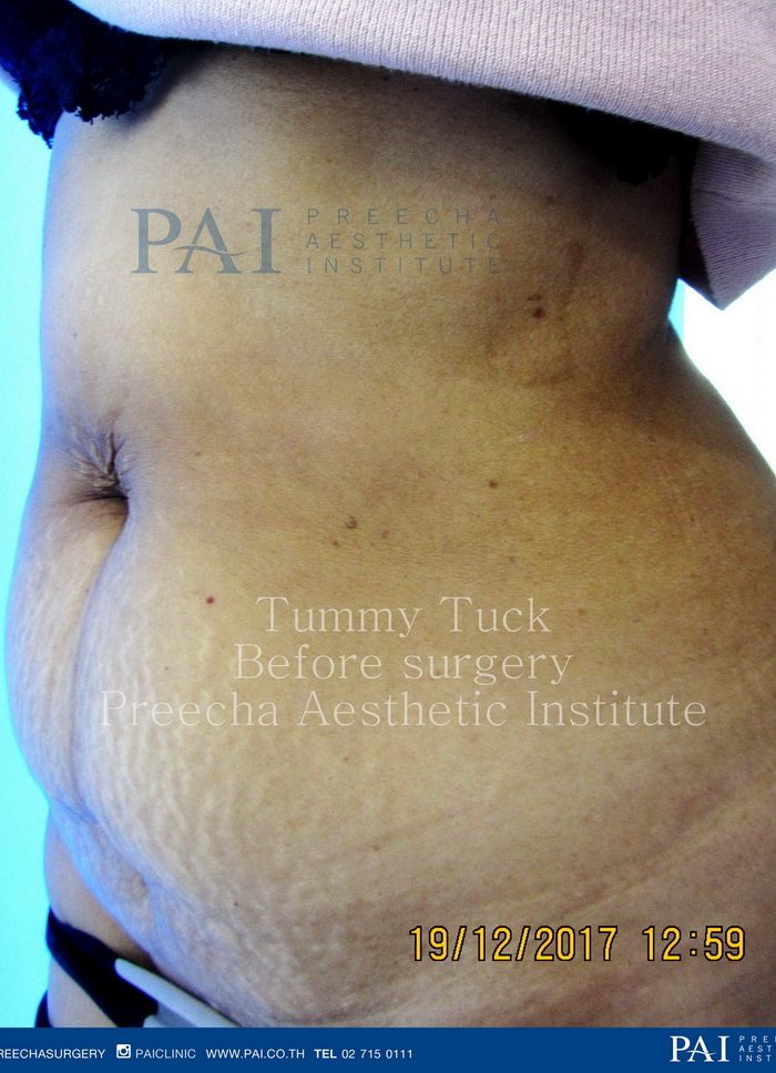 abdominoplasty tummy tuck before surgery l preecha aesthetic institute bangkok thailand