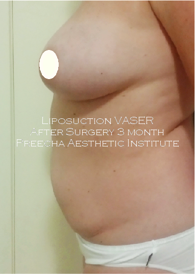 after 3 month vaser liposuction 1 1