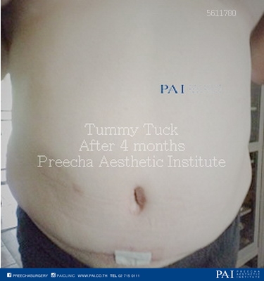 after 4 month tummy tuck preecha aesthetic institute leading cosmetic surgery thailand