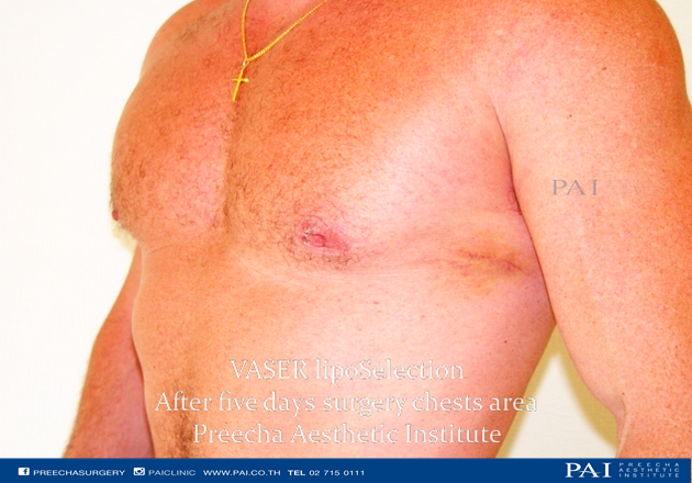 after five days chest liposuction preecha aesthetic institute