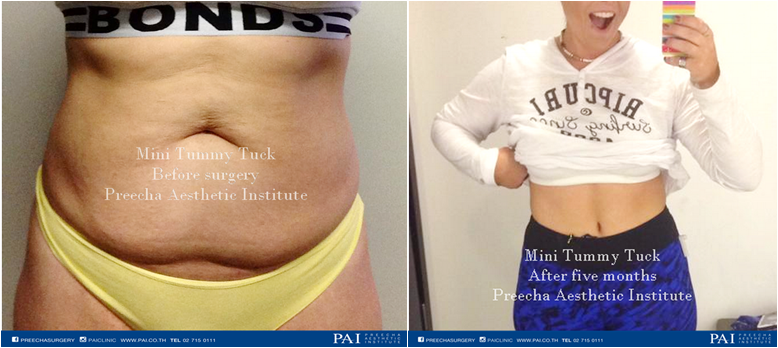 before and after five month lady mini tummy tuck preecha aesthetic institute
