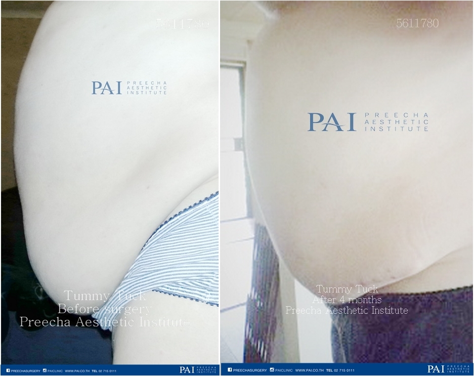before and after surgery tummy tuck preecha aesthetic institute leading cosmetic surgery thailand