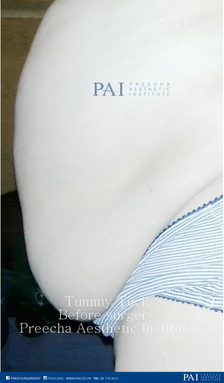 before surgery tummy tuck preecha aesthetic institute leading cosmetic surgery thailand