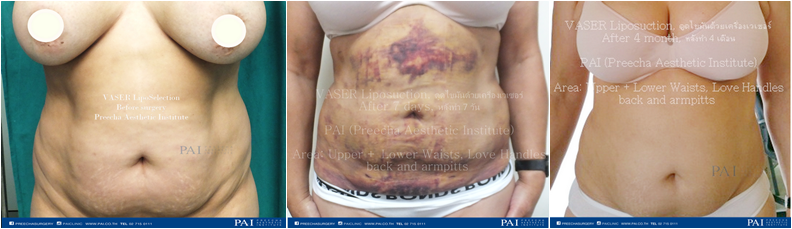before vaser lipo and after seven day and after four month