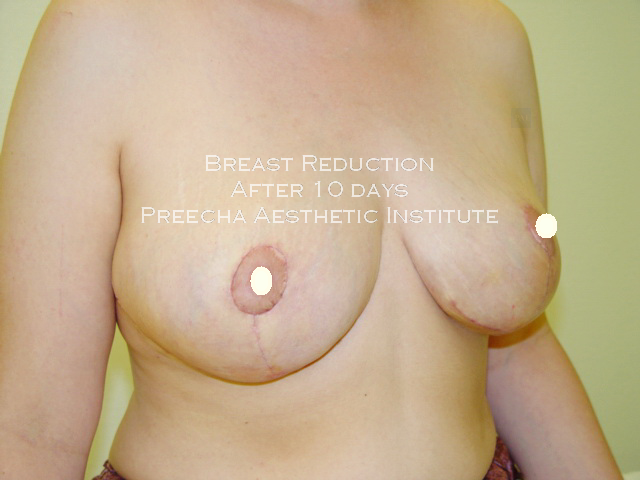 breast reduction after 10 days preecha aesthetic institute