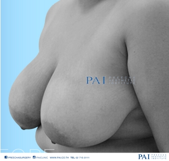 breast reduction before surgery