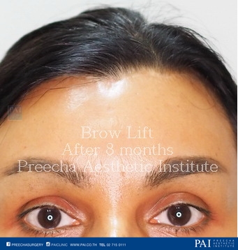 brow lift after surgery preecha aesthetic institute