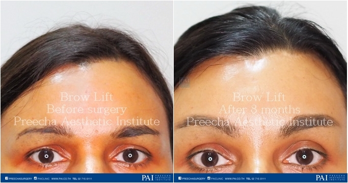 brow lift before and after surgery preecha aesthetic institute