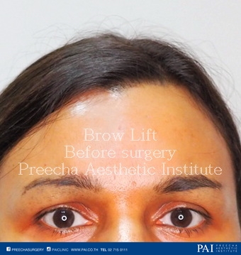 brow lift before surgery preecha aesthetic institute