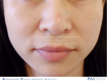cheek and chin augmentation before surgery
