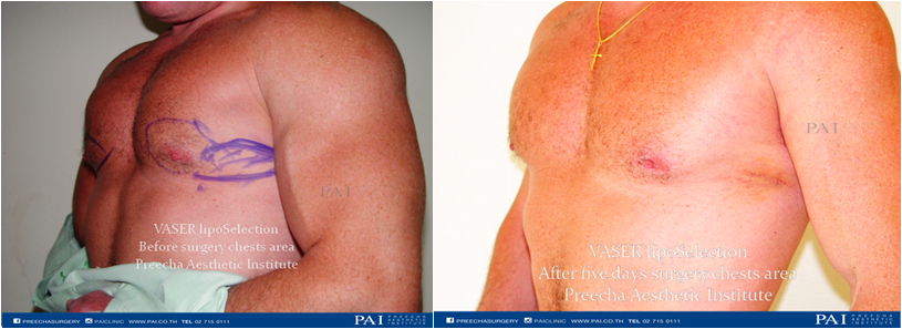 chest liposuction before and after five days surgery preecha aesthetic institute horz