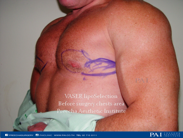 chest liposuction before surgery preecha aesthetic institute