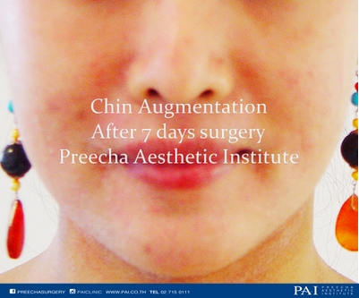 chin augmentation after 7 days l Preecha clinic