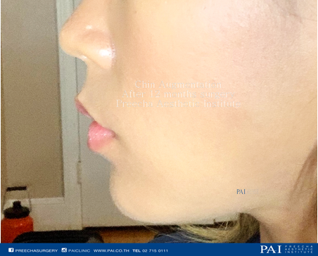 chin augmentation after one year surgery l Preecha Aesthetic Institute