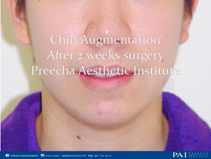 chin augmentation after two weeks surgery l Preecha Aesthetic Institute