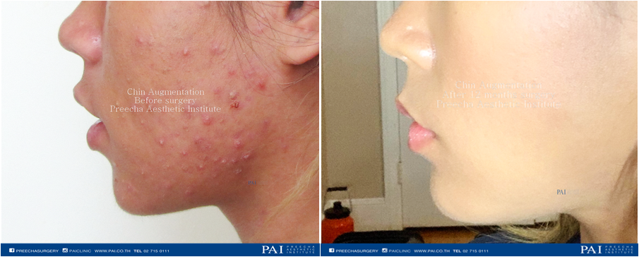 chin augmentation before and after 1 year surgery l Preecha Aesthetic Institute