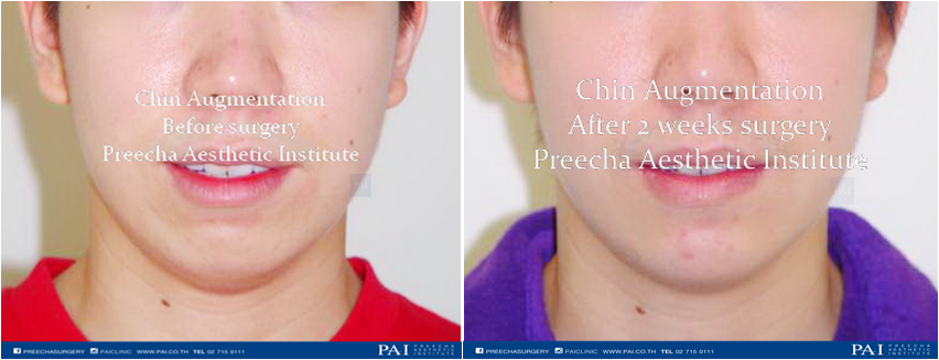 chin augmentation before and after 2 weeks surgery l Preecha Aesthetic Institute