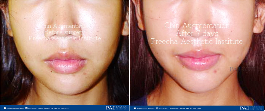 chin augmentation before and after seven day surgery l Preecha Aesthetic Institute Bangkok Thailand