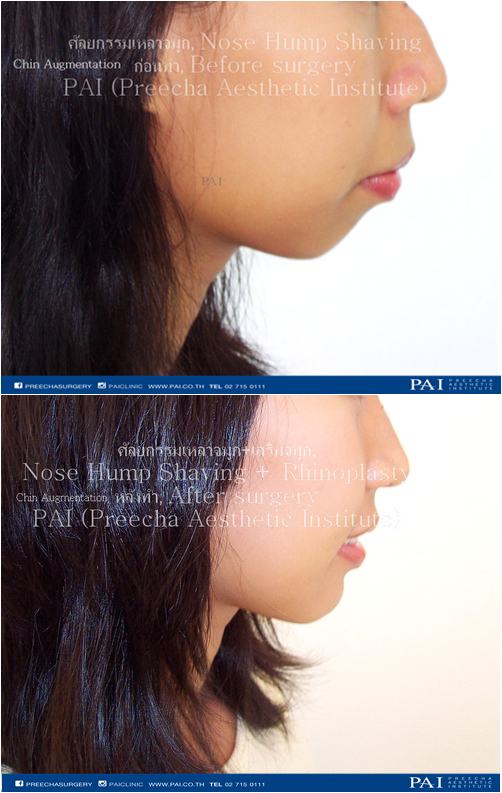 chin augmentation before and after surgery l Preecha Aesthetic Institute