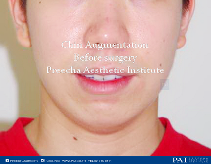 chin augmentation before surgery l Preecha Aesthetic Institute 2