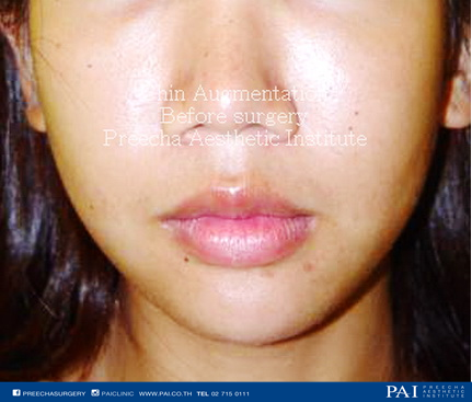 chin augmentation before surgery l Preecha Aesthetic Institute Bangkok Thailand