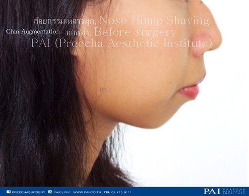 chin augmentation before surgery l Preecha Aesthetic Institute