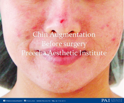 chin augmentation before surgery l Preecha clinic