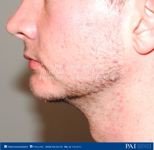 chin implant after three weeks l Preecha Aesthetic Institute