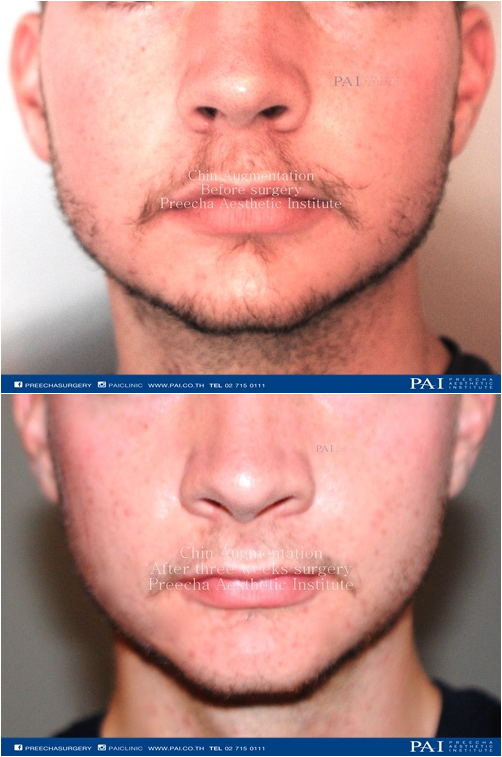 chin implant before and after 3 weeks l Preecha Aesthetic Institute