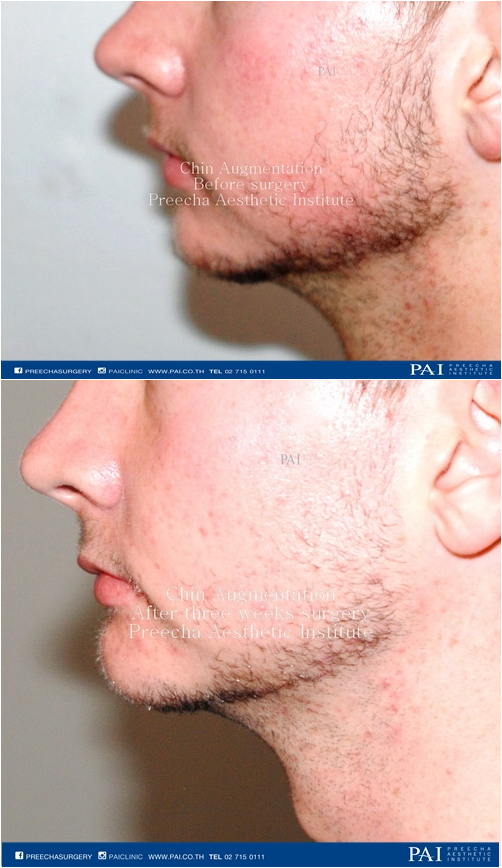 chin implant before and after surgery l Preecha Aesthetic Institute