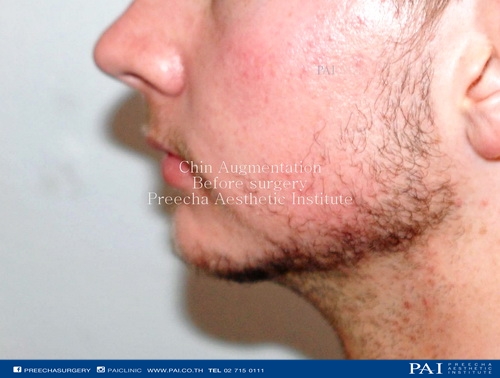 chin implant before surgery l Preecha Aesthetic Institute 1
