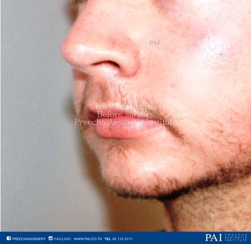 chin implant before surgery l Preecha Aesthetic Institute