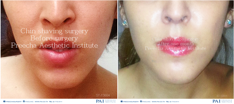 chin shaving before and after one month procedure l Preecha Aesthetic Bangkok Thailand