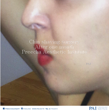 chin shaving side face after one month surgery l preecha aesthetic institute bangkok thailand