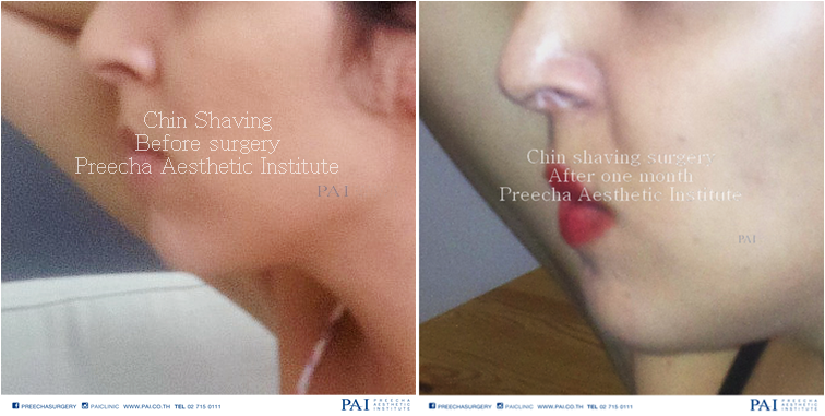 chin shaving side face before and after one month surgery l preecha aesthetic institute bangkok thailand