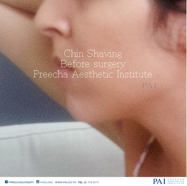 chin shaving side face before surgery l preecha aesthetic institute bangkok thailand